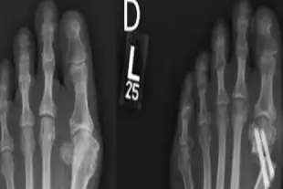 Foot & Ankle Surgery